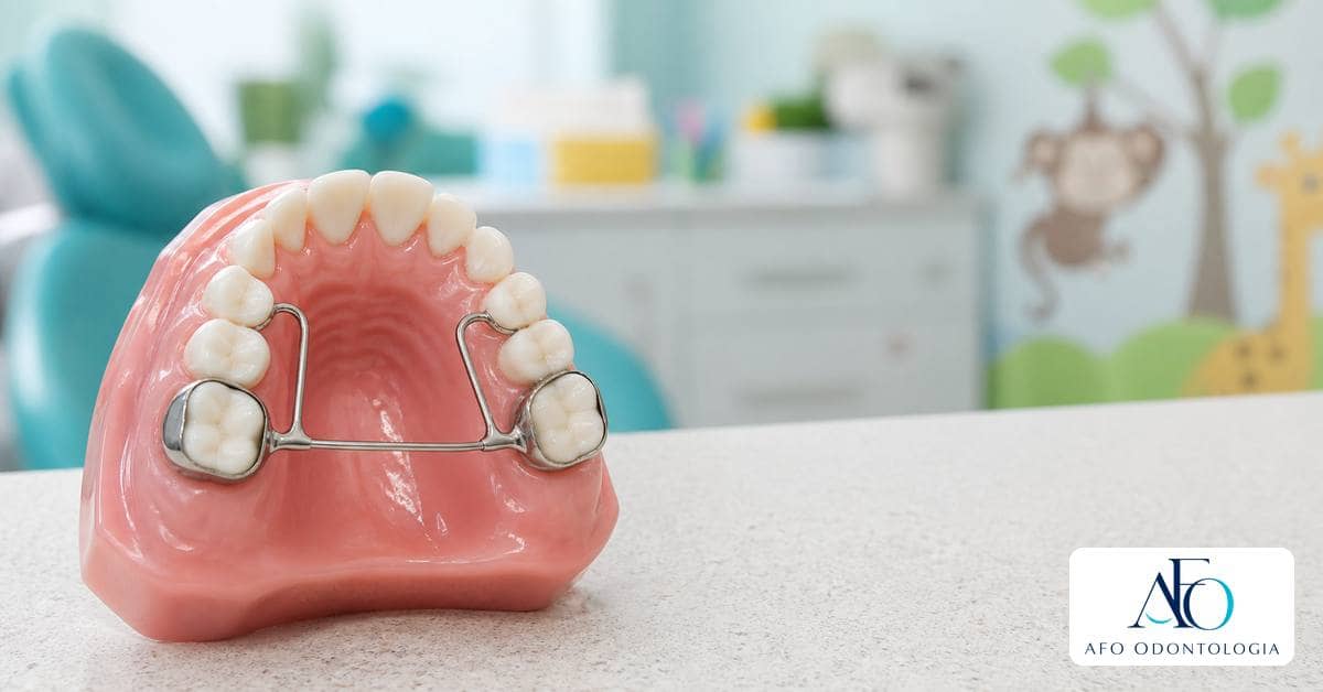 Modelo dental infantil com mantenedor de espaco