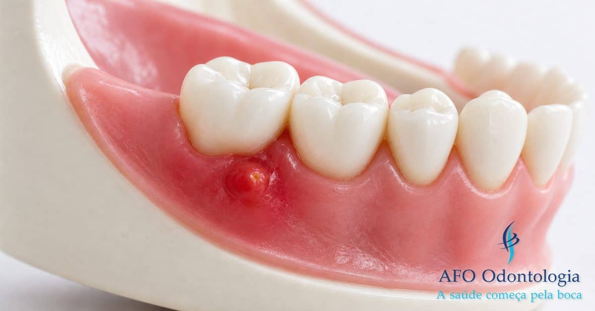 Abscesso dentário na gengiva — infecção localizada que pode se disseminar se não tratada, Taboão da Serra