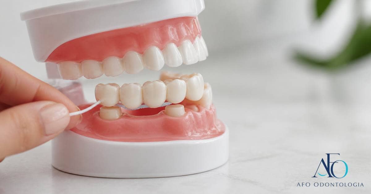 Passa-fio sob ponte fixa em modelo dental com composição instrutiva