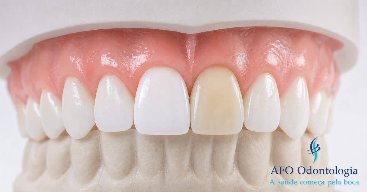 Dente com restauração de resina e coroa cerâmica — clareamento não altera cor de materiais restauradores, Taboão da Serra