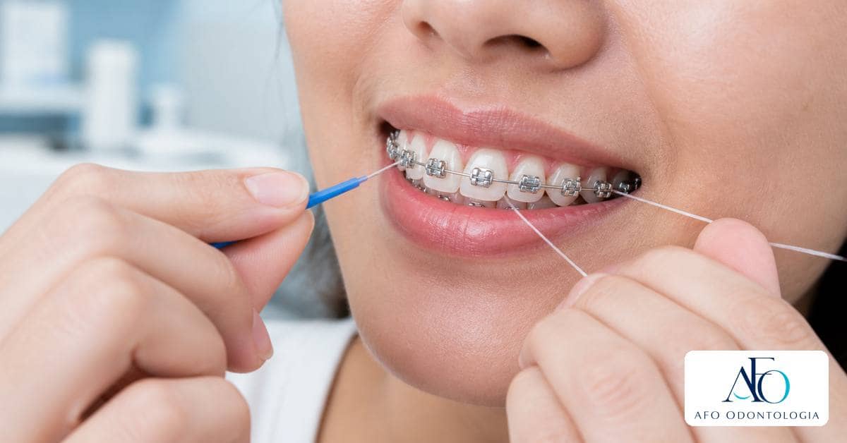 Ilustração educativa sobre Como usar fio dental com aparelho fixo sem machucar
