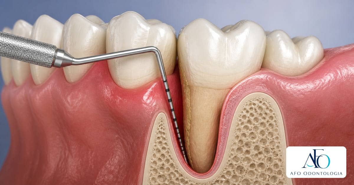 Ilustração educativa sobre Bolsa periodontal: o que significa e como é tratada