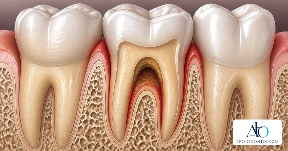 Ilustração educativa sobre Lesão de furca periodontal: quando a periodontite alcança entre as raízes