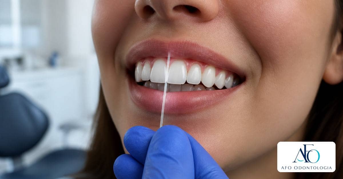 Ilustração para o artigo Dentes inclinados depois do aparelho: recidiva ou outra causa?