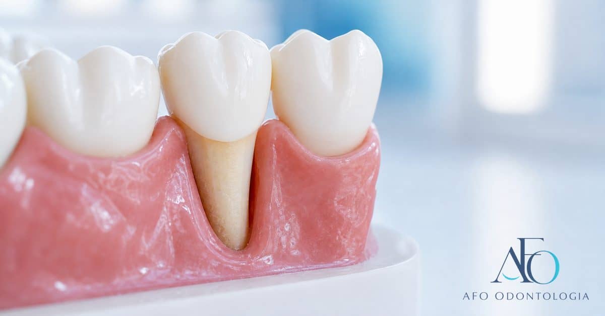 Close-up de dente com retração gengival expondo a raiz, ilustrando o que fazer contra a gengiva retraída em Taboão da Serra