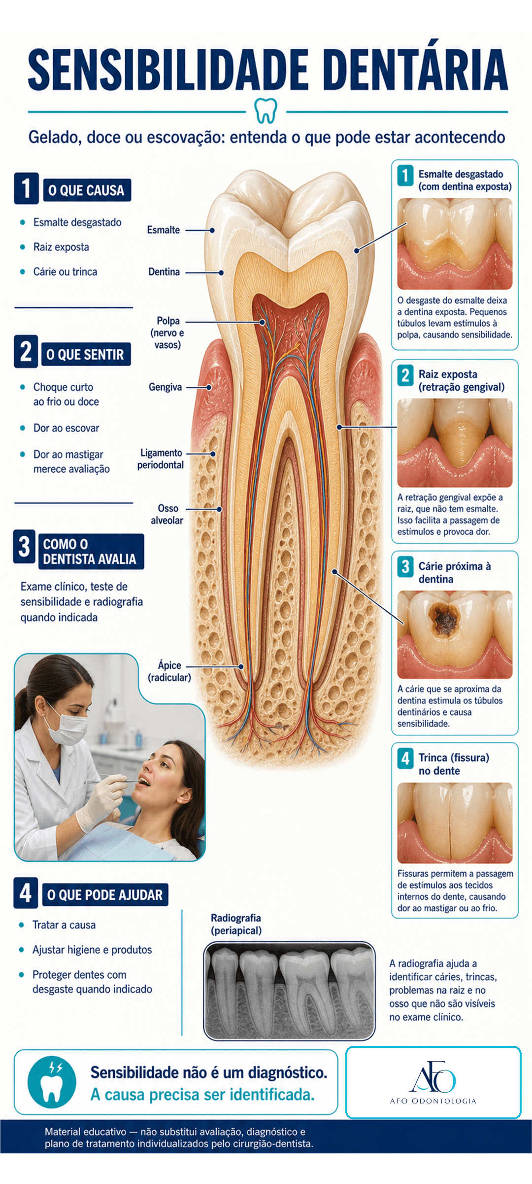 Infográfico sobre sensibilidade dentária, esmalte desgastado, raiz exposta, cárie e trinca