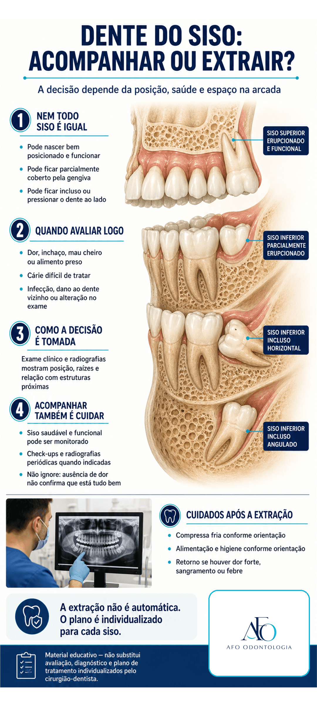 Infográfico sobre dentes do siso, posições comuns, indicação de acompanhamento ou extração e cuidados após cirurgia