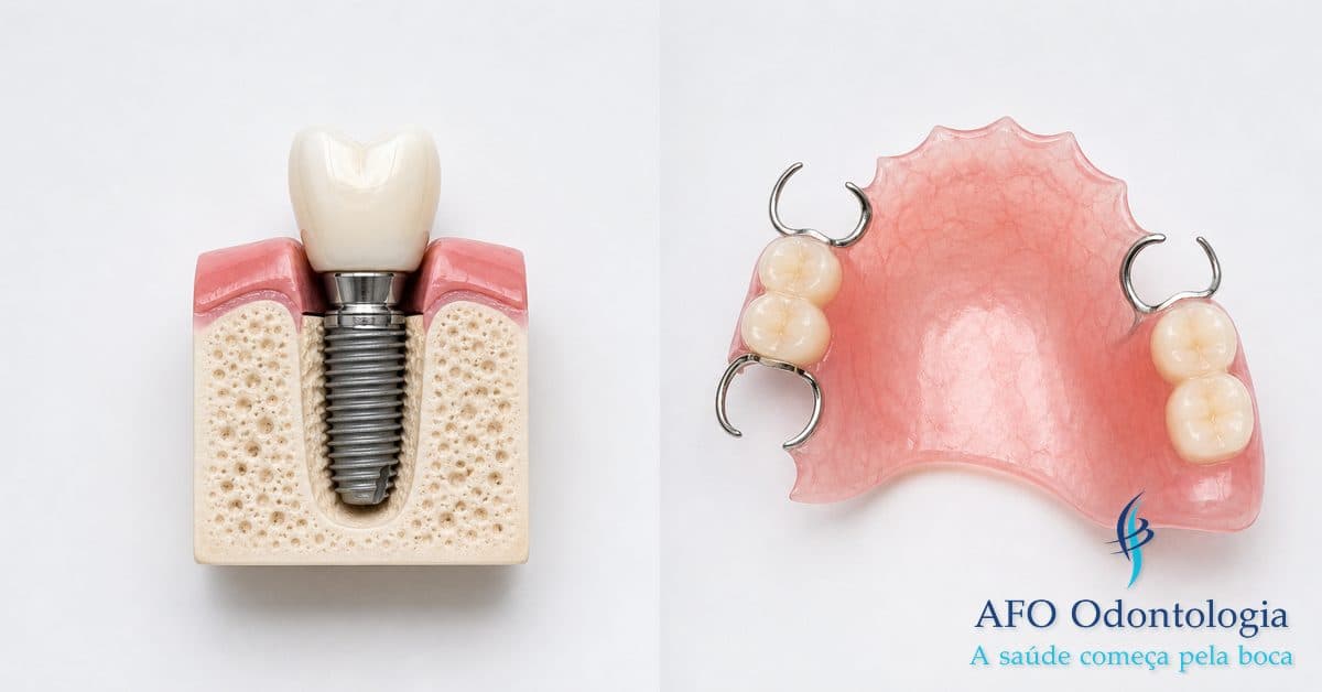 Comparação entre implante dentário e prótese — opções de reabilitação oral, Taboão da Serra