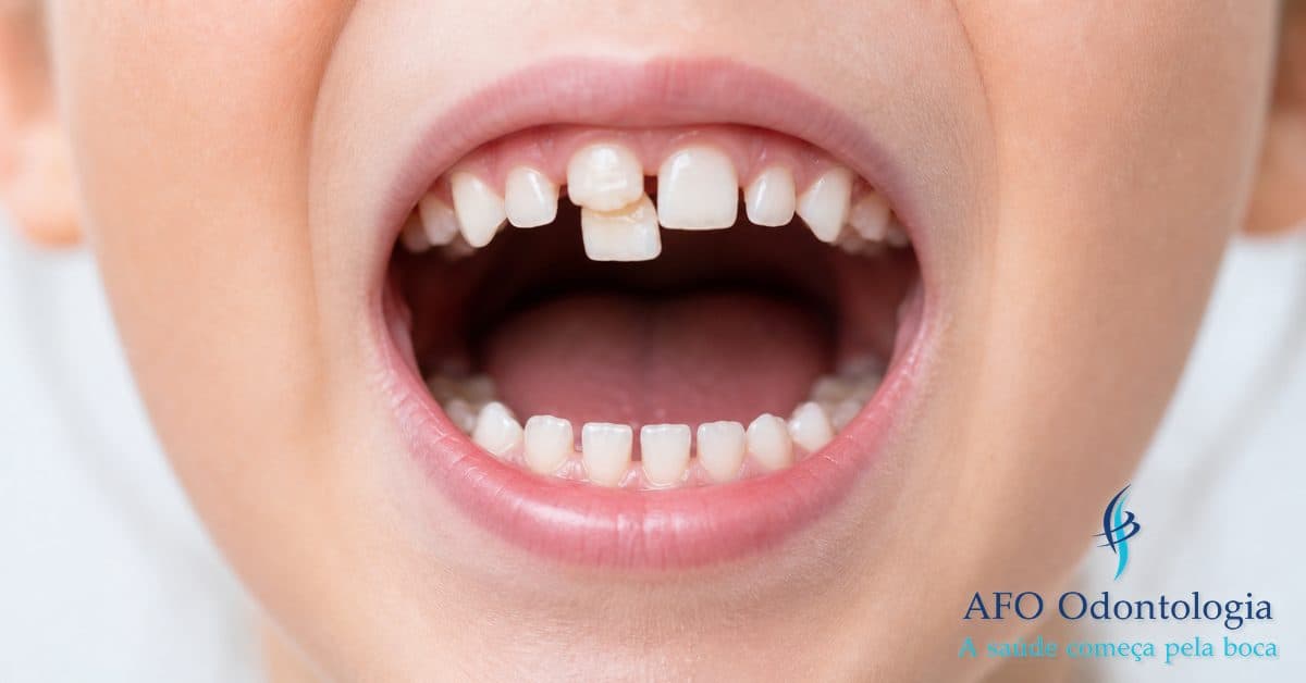Dente tubarão em criança — dente permanente nascendo atrás do dente de leite, Taboão da Serra
