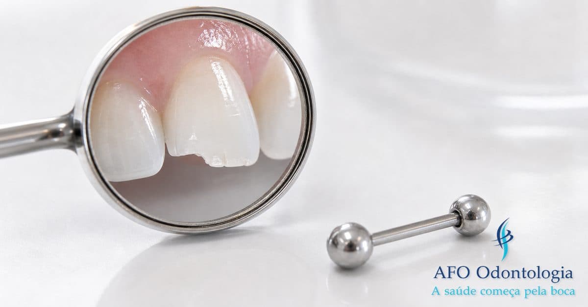 Piercing na língua — riscos de fratura dental e recessão gengival, Taboão da Serra