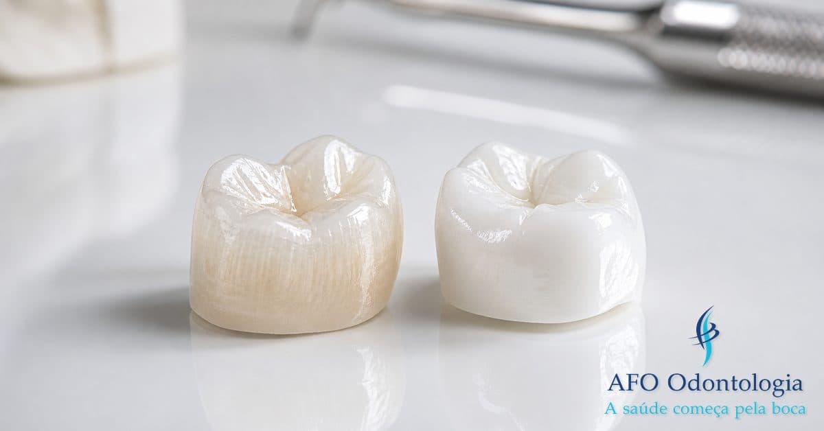 Coroa dentária — resultado do cuidado preventivo regular com dentista, Taboão da Serra