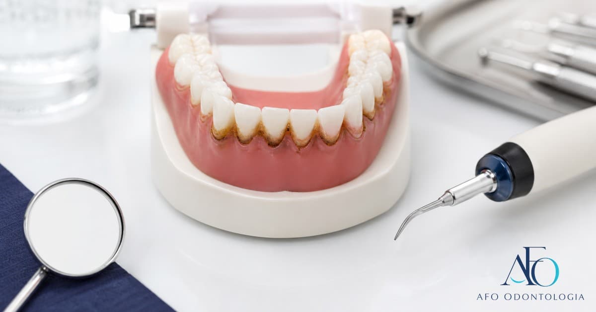 Tártaro amarelo e escuro sobre dentes em modelo odontológico, explicando remoção segura em Taboão da Serra
