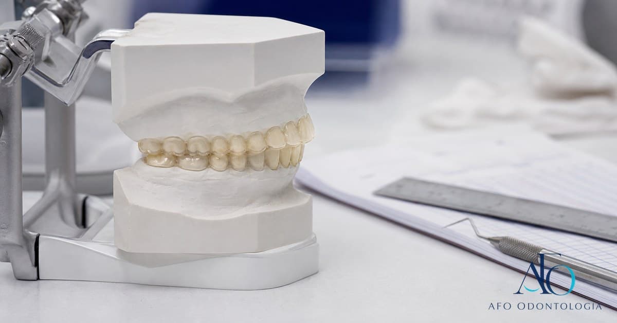 Modelo dental demonstrando mordida profunda com sobreposição dos dentes anteriores em Taboão da Serra