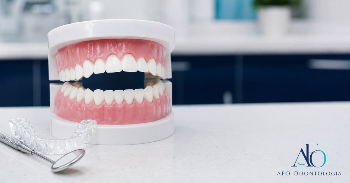 Modelo dental com mordida aberta anterior, explicando tratamento ortodôntico em Taboão da Serra