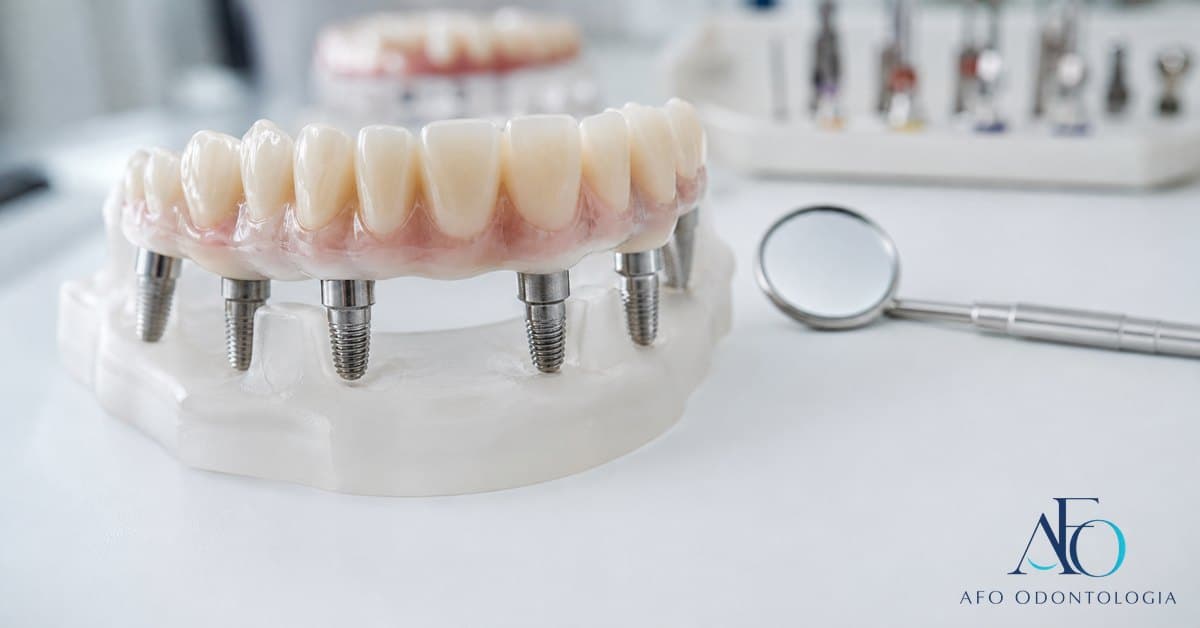 Prótese protocolo fixa sobre múltiplos implantes em bancada odontológica, ilustrando reabilitação em Taboão da Serra