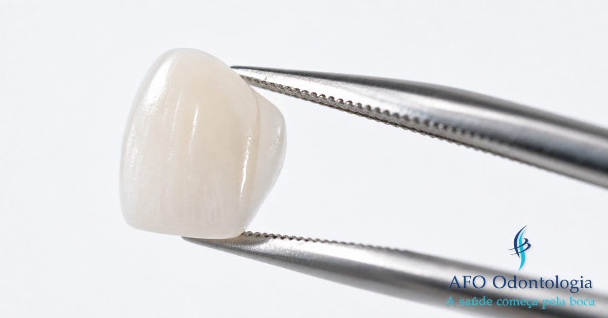 Facetas de porcelana ultrafinas sobre suporte clínico — tratamento estético dental com resultado natural, Taboão da Serra
