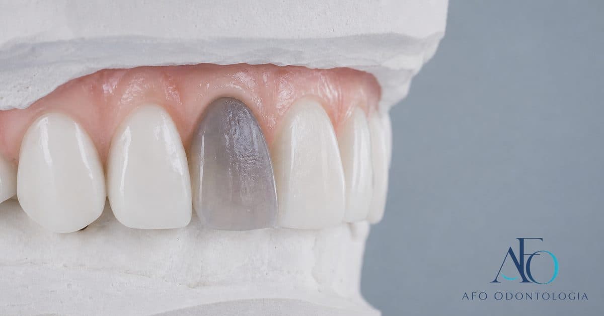 Sorriso com um dente incisivo visivelmente mais escuro que os vizinhos após trauma, ilustrando necrose pulpar e clareamento interno em Taboão da Serra