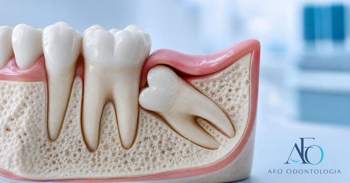 Radiografia panorâmica destacando dente do siso incluso na região posterior da mandíbula, indicação de cirurgia de extração em Taboão da Serra