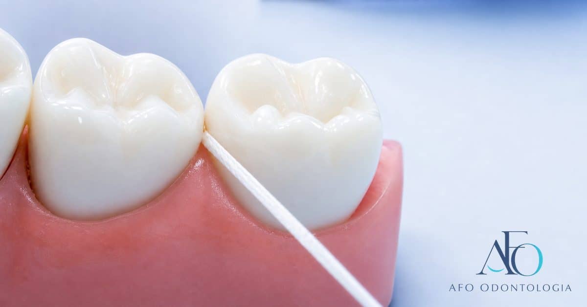 Radiografia bite-wing evidenciando cárie interproximal entre os dentes, região de difícil visualização a olho nu, em Taboão da Serra