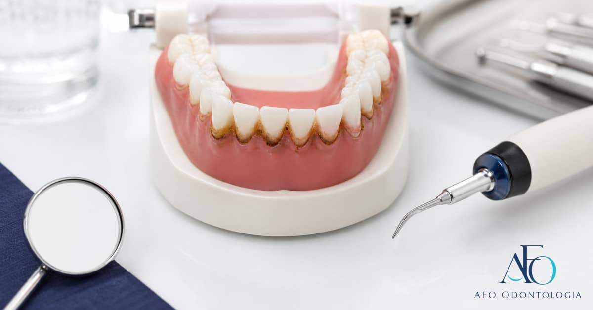 Tártaro amarelo e escuro sobre dentes em modelo odontológico, explicando remoção segura em Taboão da Serra